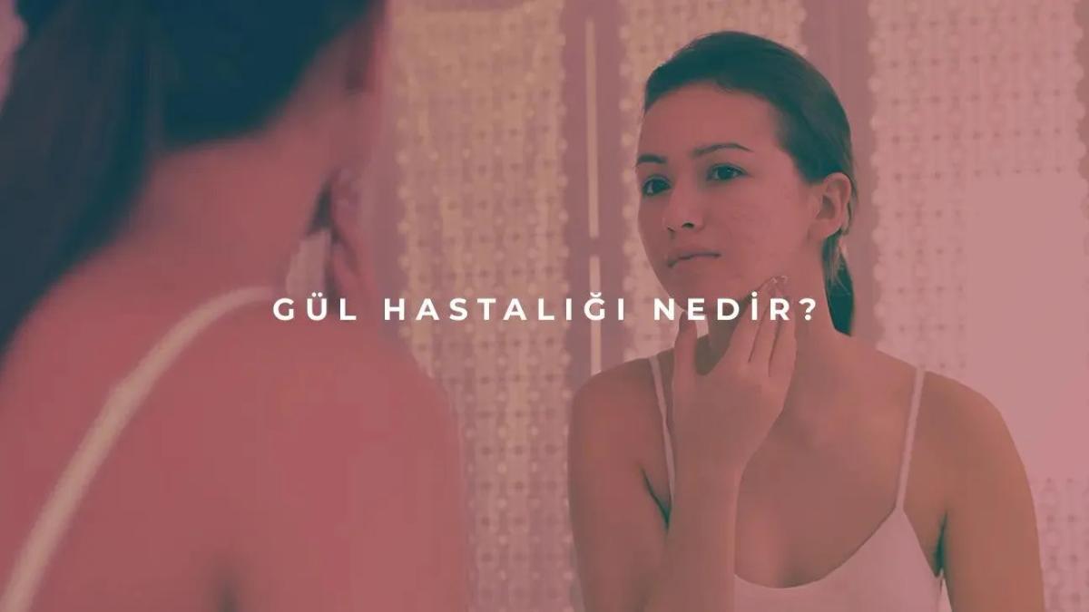 Gül Hastalığı (Rosacea) Nedir?