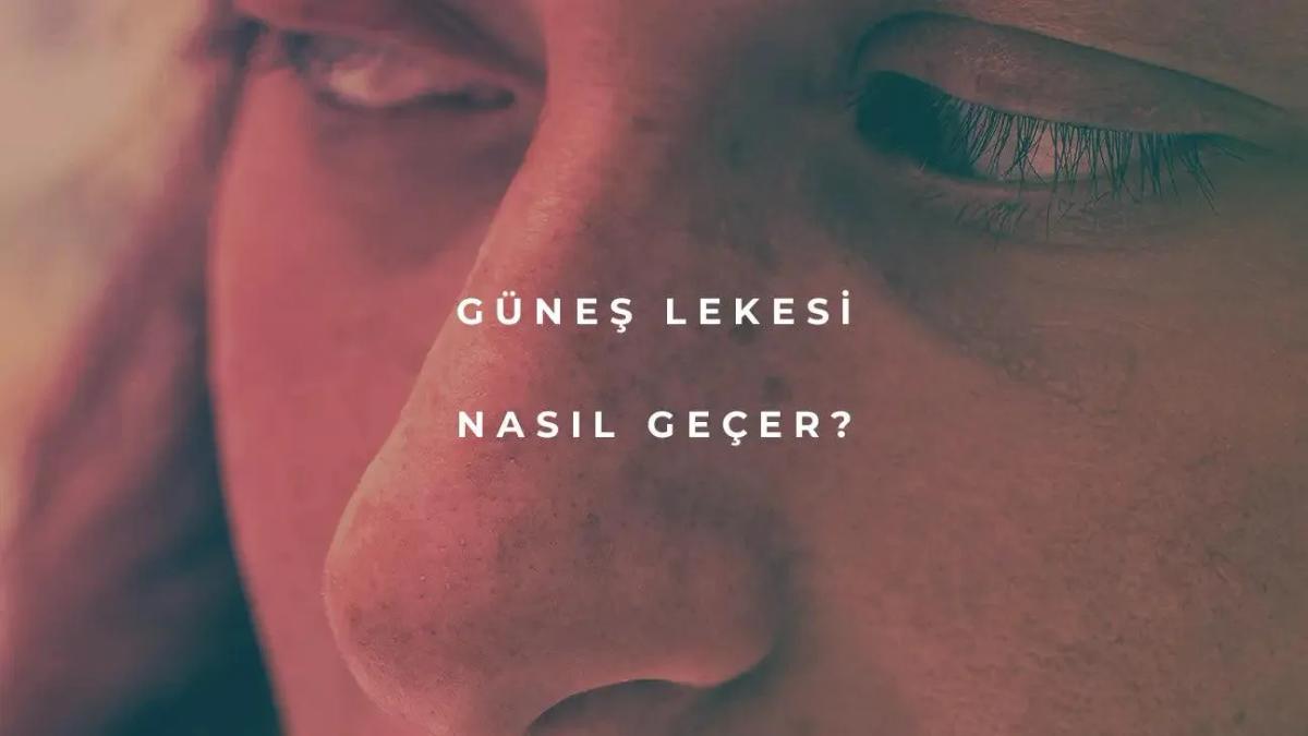 Güneş Lekesi Nasıl Geçer?