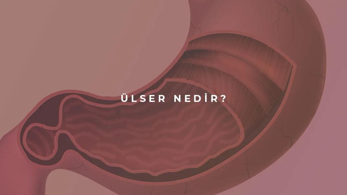 Ülser Hastalığı Nedir?